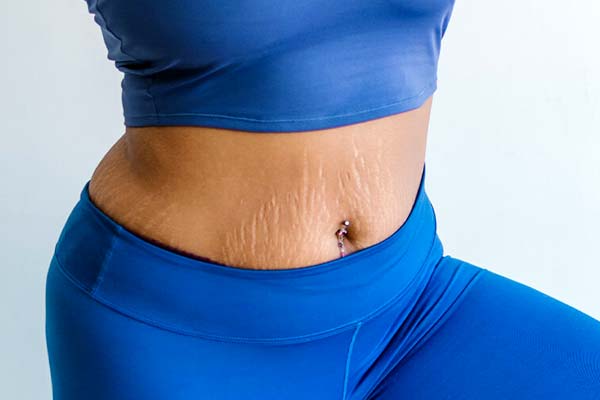 علاج التمدد الجلدي بزبدة الكاكاو: الطريقة الفعالة للحصول على بشرة ناعمة ومشدودة